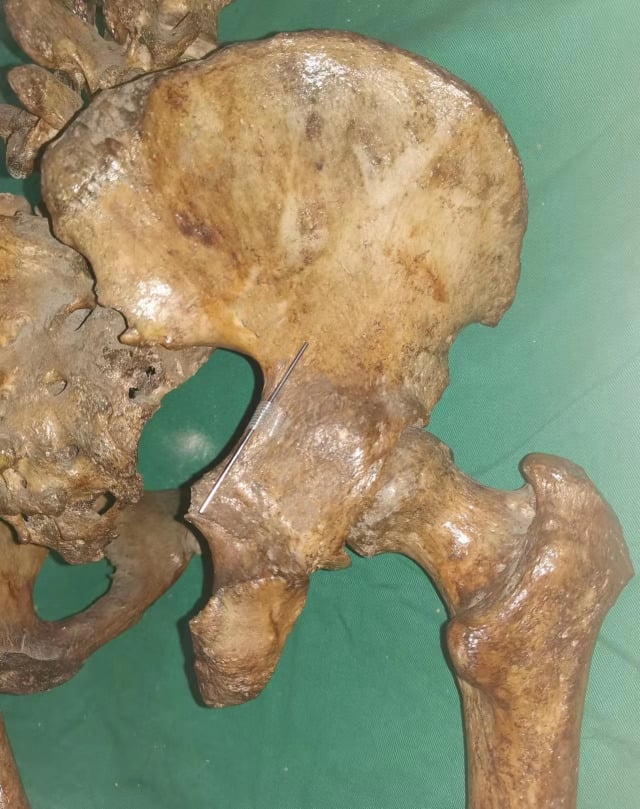 External view of a right cadaveric hemipelvis with a Kirschner wire along the posterior surface of the posterior column at the greater sciatic notch