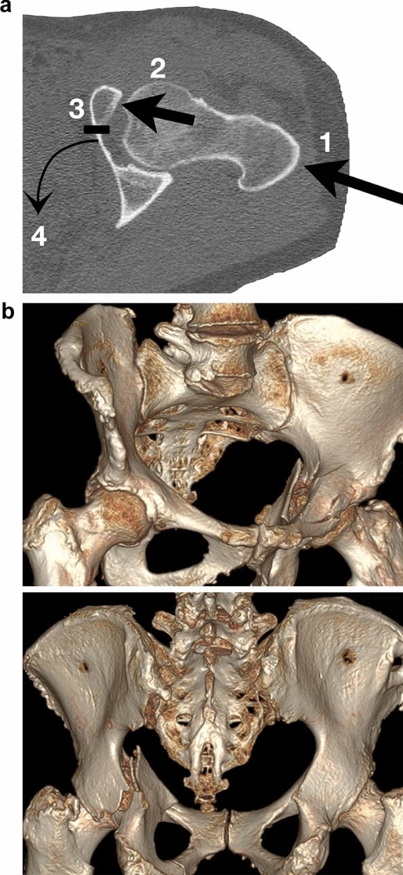 Diagram and three-dimensional CT of force transmission through the greater trochanter to the anterior superior acetabulum producing an anterior column posterior hemitransverse pattern