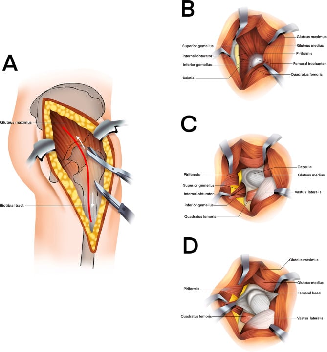 Illustrated Kocher-Langenbeck approach showing the skin incision, fascia lata division, gluteus maximus split and the short external rotators with the sciatic nerve