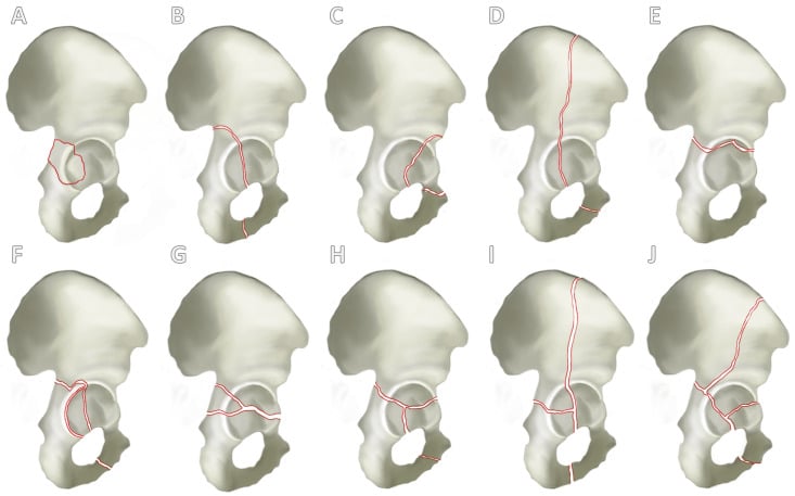 Ten three-dimensional pelvis models illustrating the five elementary and five associated Letournel fracture patterns