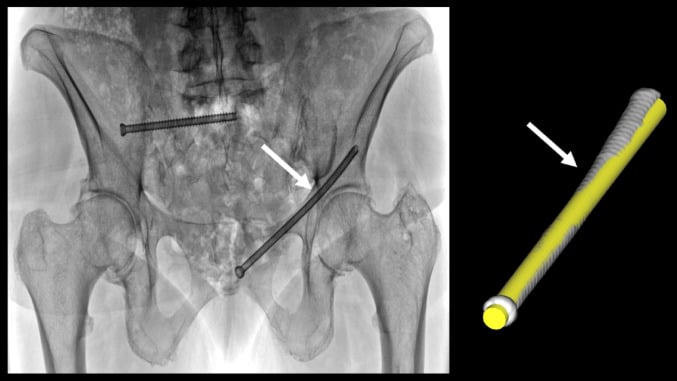 Anteroposterior fluoroscopic view of a retrograde pubic ramus screw with postoperative three-dimensional CT and a superimposed straight cylindrical model showing screw curvature
