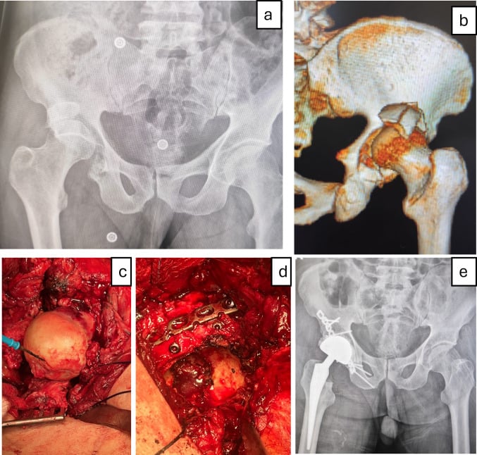 Preoperative radiograph and three-dimensional CT of a neglected comminuted posterior wall fracture with intraoperative photographs of lag screw and reconstruction plate fixation