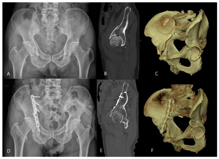 Anteroposterior radiograph, sagittal CT reconstruction and three-dimensional CT of an acetabular fracture with matched postoperative images