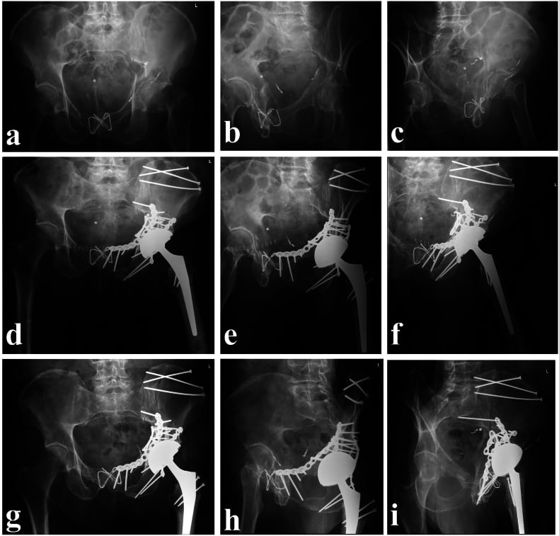 Preoperative anteroposterior, obturator and iliac radiographs with postoperative films after staged open reduction and internal fixation followed by hip arthroplasty