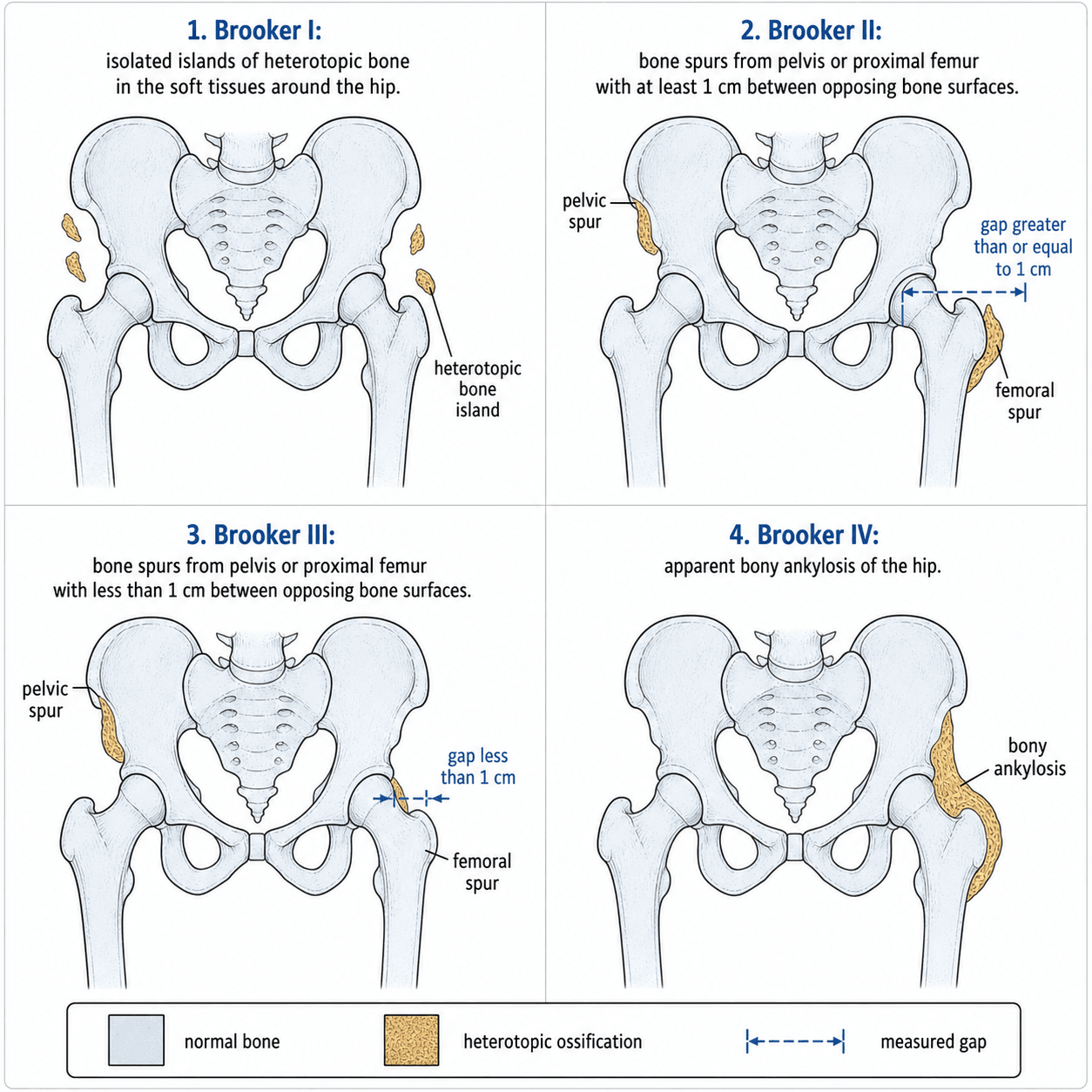 Brooker classification of heterotopic ossification around the hip: I islands, II spurs leaving at least 1cm gap, III spurs leaving less than 1cm gap, IV ankylosis