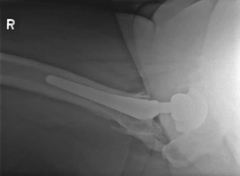Lateral hip radiograph after total hip arthroplasty showing heterotopic ossification in the periprosthetic soft tissues.