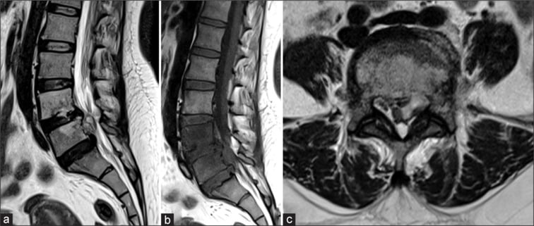 Sagittal T1, T2, and post-contrast MRI demonstrating Pedro Pons sign in spinal brucellosis