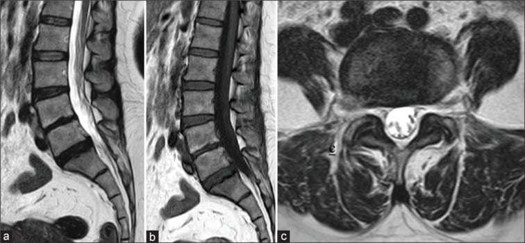 Sagittal and axial MRI demonstrating epidural phlegmon in brucellar spondylodiscitis
