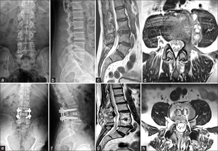 Follow-up CT and MRI demonstrating osteophytic bridging and resolution of spinal brucellosis