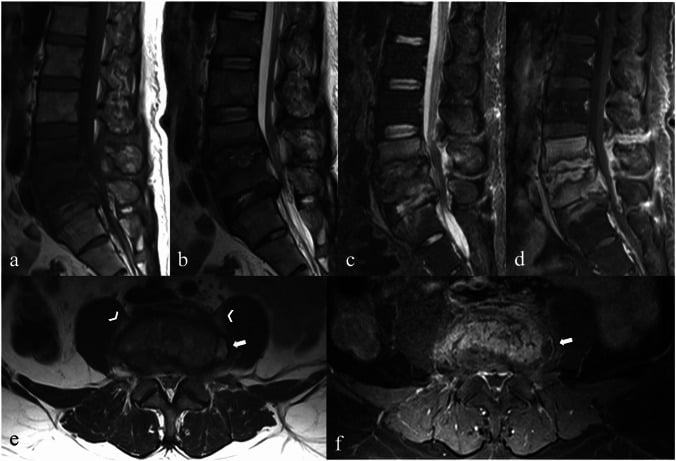 Comparative MRI features of brucellar vs pyogenic vs tuberculous spondylodiscitis