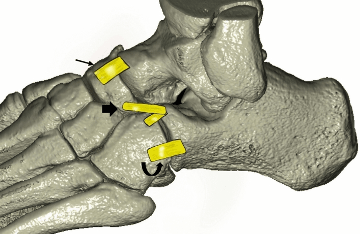 Three-dimensional CT reconstruction of the hindfoot and midfoot with the Chopart ligaments, including the dorsal calcaneocuboid and bifurcate ligaments, drawn in yellow and marked by arrows