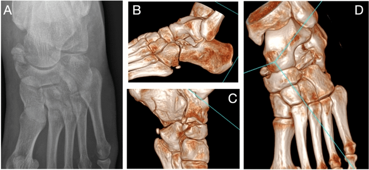 Radiograph (A) and three-dimensional CT reconstructions (B to D) of a Chopart injury involving the anterior calcaneal process, with reference lines drawn on the reconstructions