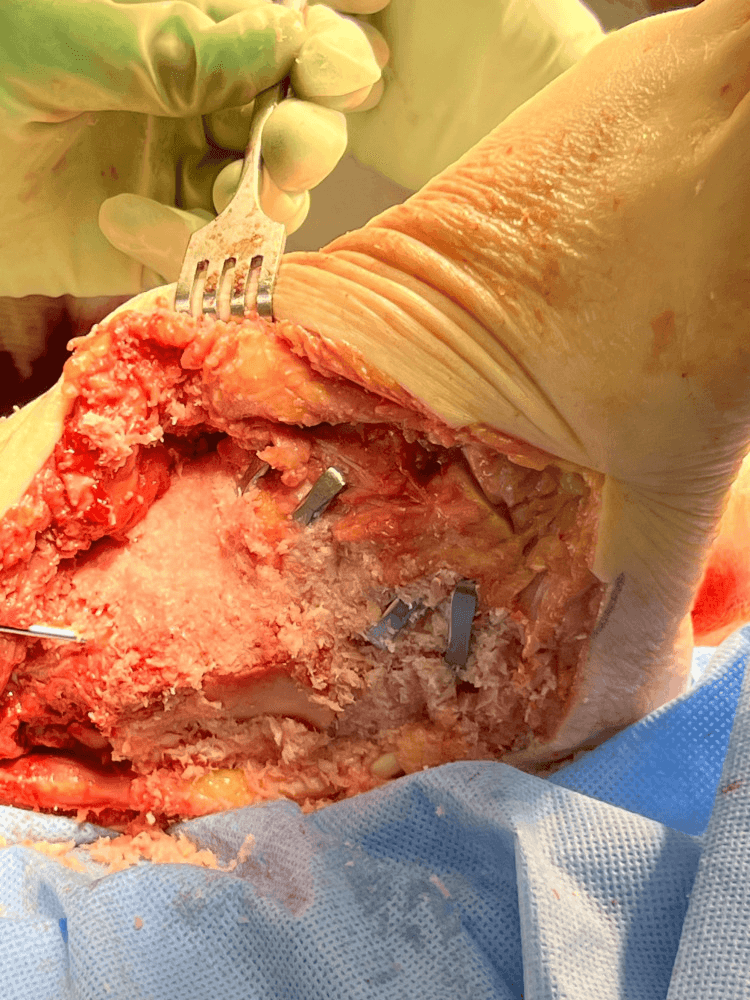 Intra-operative view of a triple arthrodesis with the prepared joint surfaces packed with bone graft and held with metal implants