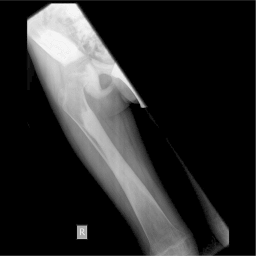 AP radiograph of the right femur showing diffuse diaphyseal cortical hyperostosis