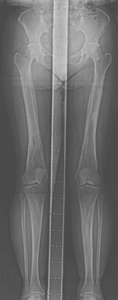 Bilateral lower-limb AP scannogram showing symmetric diaphyseal cortical thickening of both femora and tibiae