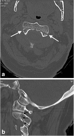 Axial and sagittal CT of the cervical spine showing bilateral C2 pars fractures (a hangman's fracture).