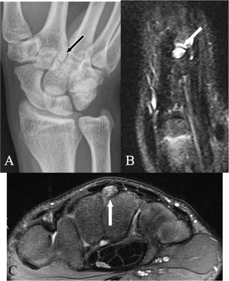 Radiograph and MRI showing an os styloideum with marrow oedema in an acutely painful carpal boss