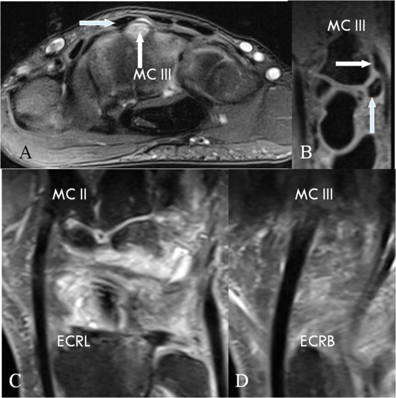 MRI showing an os-styloideum carpal boss displacing and inflaming the ECRB tendon