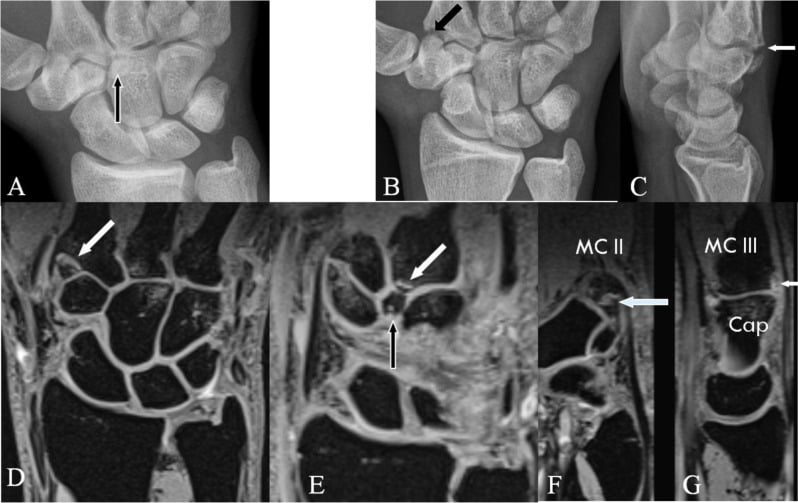 Radiographs and MRI distinguishing an os styloideum from acute second and third metacarpal base fractures
