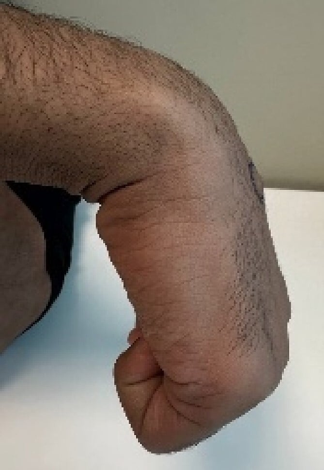 Clinical photograph showing a fixed dorsal carpal boss made prominent by wrist flexion
