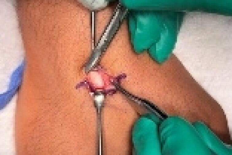 Operative dorsal approach exposing an overlying ganglion and underlying carpal boss