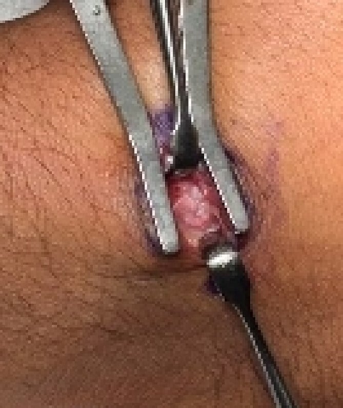 Operative exposure of the carpal boss through a dorsal quadrangular-joint approach