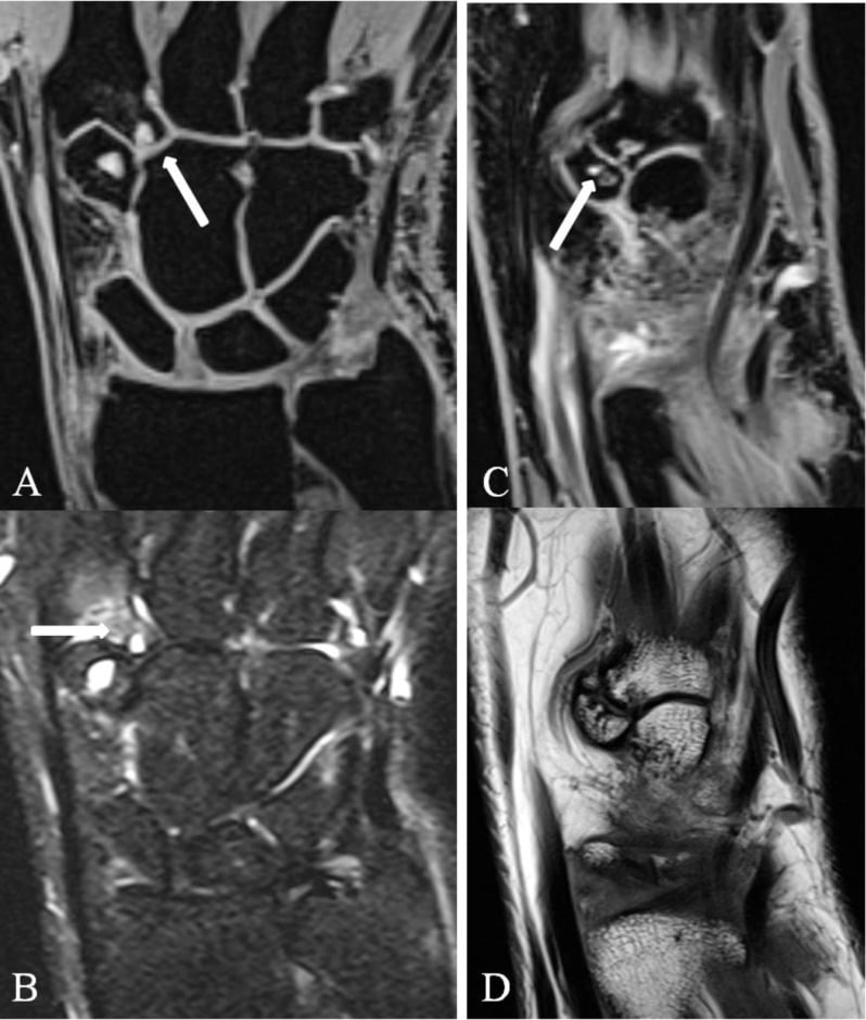 Multiplanar MRI showing variant dorsal pseudoarticulations at the second and third CMC joints