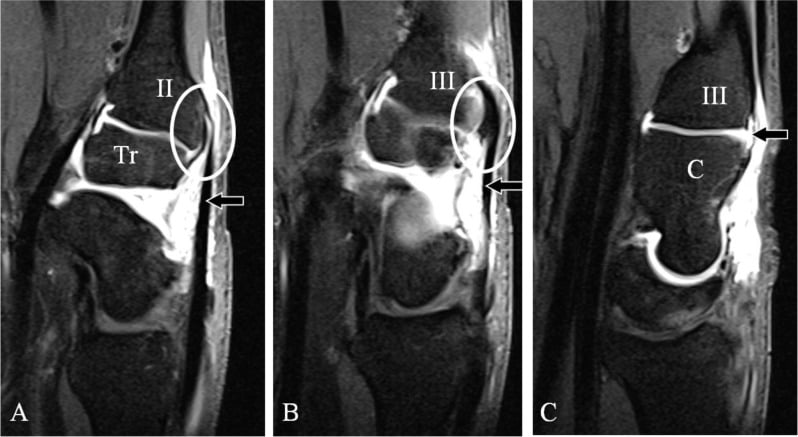 MR arthrography showing the dorsal CMC ligaments and ECRL and ECRB insertions