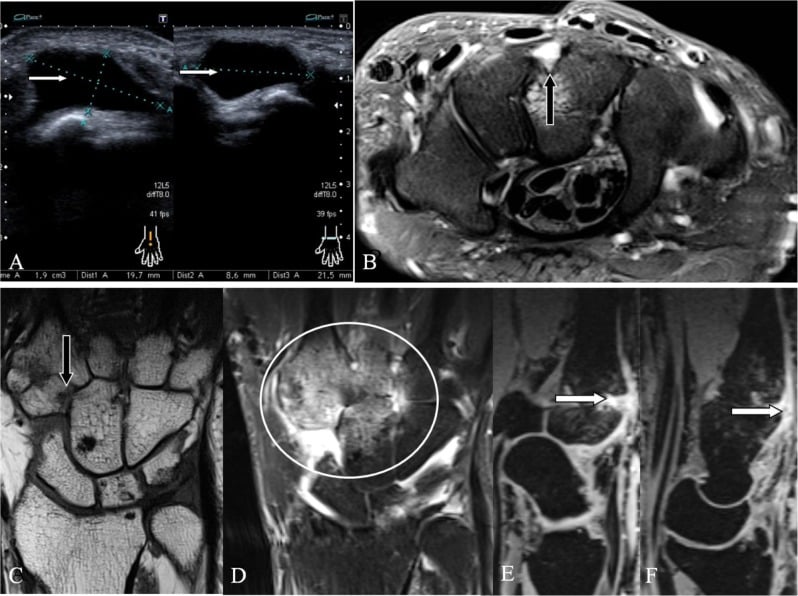 Ultrasound and MRI showing dorsal ganglion cysts and rheumatoid synovitis around the quadrangular joint