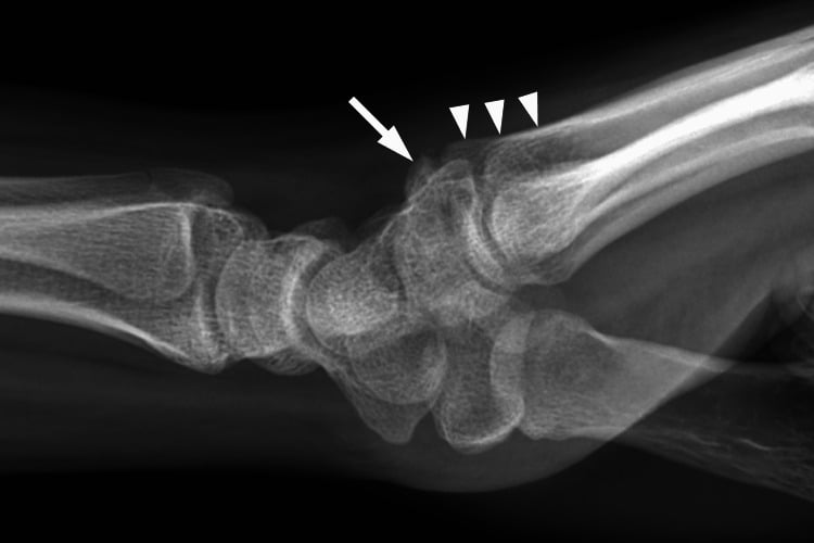 Lateral wrist radiograph showing a corticated os styloideum beside the third-metacarpal base