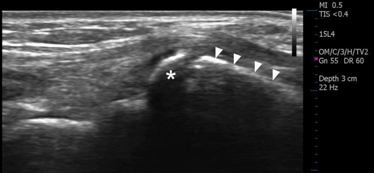 Longitudinal ultrasound showing an os styloideum at the symptomatic third-metacarpal base