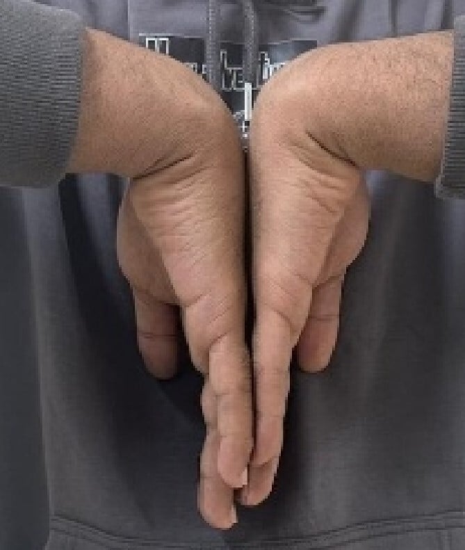 Clinical photographs showing wrist range of motion two months after carpal boss excision