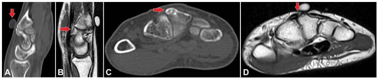CT and MRI showing a dorsal third-metacarpal carpal boss articulating with the capitate