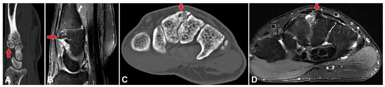 CT and fluid-sensitive MRI showing a third-metacarpal and trapezoid carpal boss with marrow oedema
