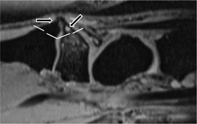 Sagittal MRI showing a volcano-shaped carpal boss osteophyte and planned wedge resection