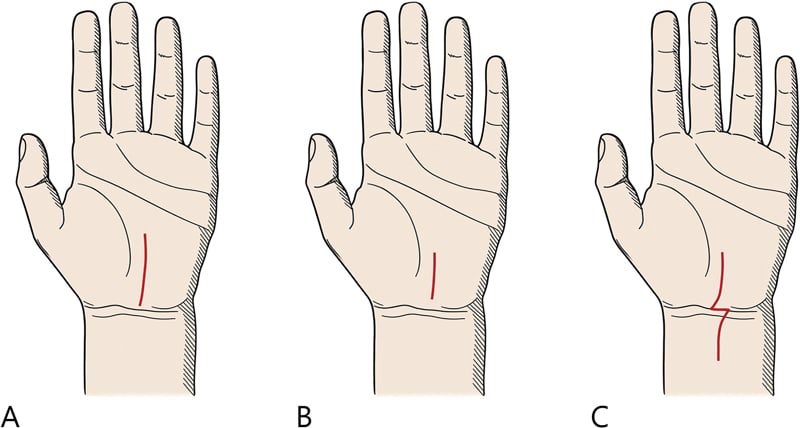 Schematic of the various incisions for carpal tunnel release