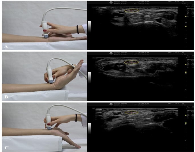 Ultrasound of the median nerve at the distal radius in different wrist positions