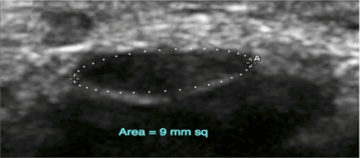 Transverse ultrasound of the median nerve outlined at the carpal tunnel inlet