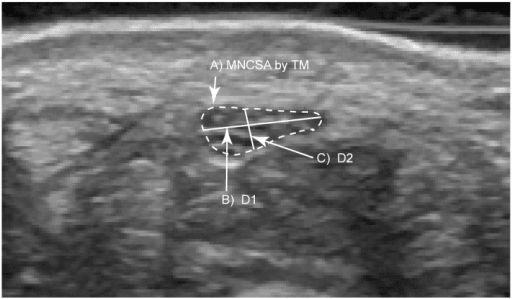 Ultrasound of the median nerve with cross-sectional area tracing and longitudinal diameter
