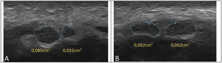 Ultrasound examples of a bifid median nerve with cross-sectional areas