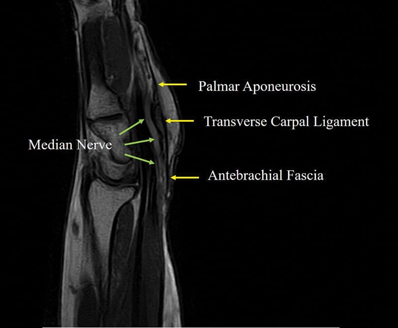 Sagittal MRI of severe carpal tunnel syndrome showing the compressed median nerve