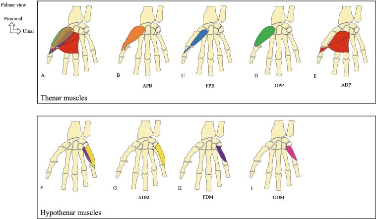 Schematic of the thenar and hypothenar muscles and their bony insertions