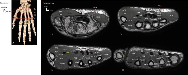 Transverse MRI of the normal intrinsic muscles of the hand at several levels