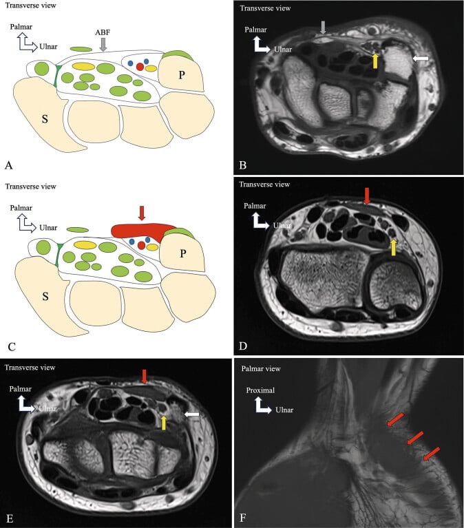 Schematic and MRI of an accessory abductor digiti minimi muscle variant