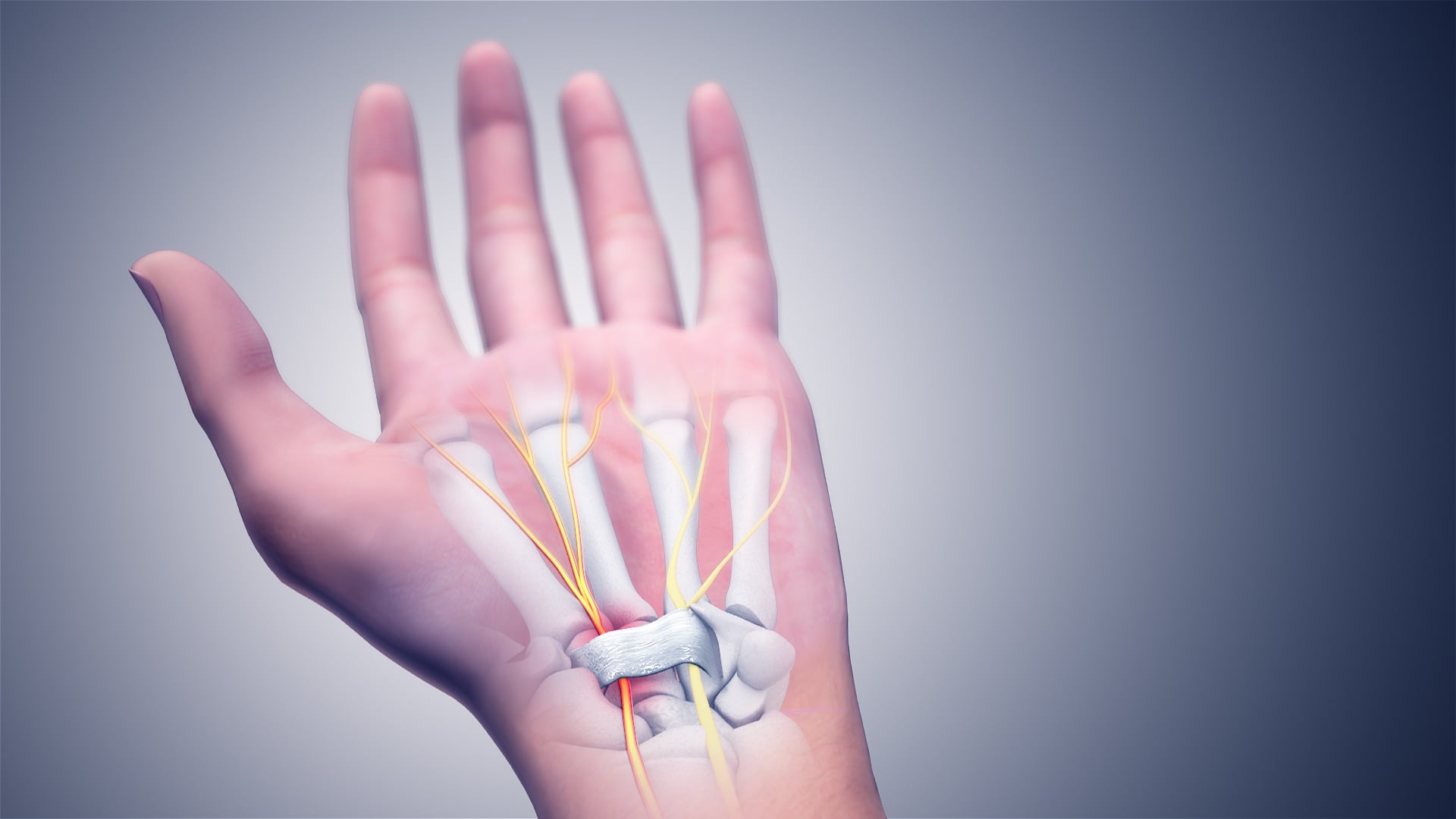 Illustration of the median nerve compressed beneath the transverse carpal ligament in the carpal tunnel.
