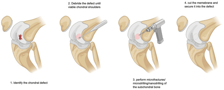 Four-step schematic of autologous matrix-induced chondrogenesis in the knee