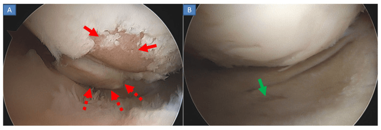 Arthroscopic views showing cartilage erosion and a loose fragment in A, and a second area of surface damage in B