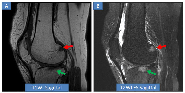 Sagittal T1-weighted and fat-suppressed T2-weighted knee MRI with arrows marking a femoral condylar lesion and a signal change in the tibia