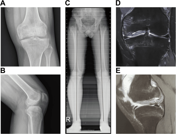 Knee radiographs, a full-length lower-limb radiograph and knee MRI used to plan treatment of an osteochondral defect