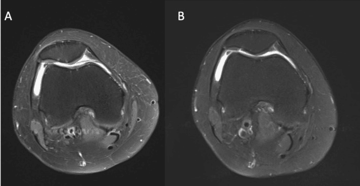 Five-year axial knee MRI after isolated microfracture, labelled A and B